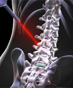 Spine Laser Treatment Facilities at Indian Spinal Injuries Centre