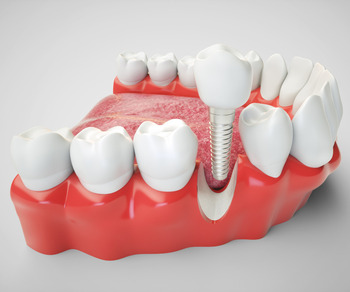 Icon of Dental Implant Facilities, Kabir Kid's Clinic & Diagnostic Center