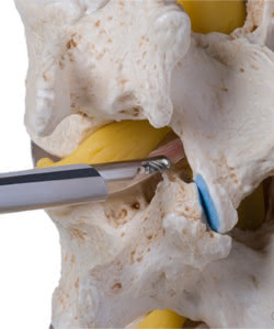 Spine Endoscopy Services at Atlas Spine Clinic