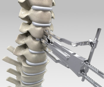 Spine Microscopic Surgical Facilities at Atlas Spine Clinic